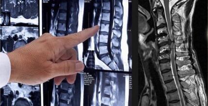 Diagnosi di mal di schiena