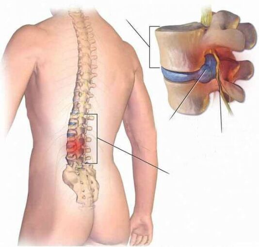 Ernia intervertebrale